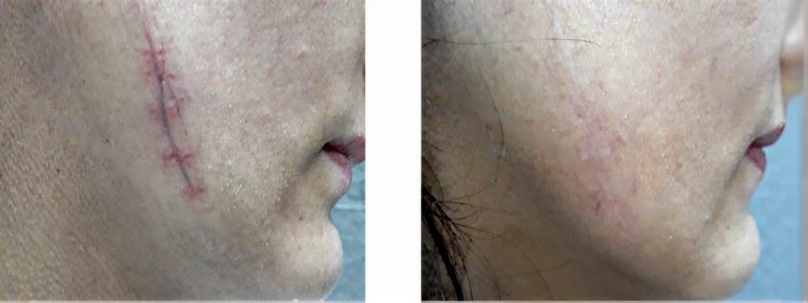 Consultation cicatrices traumatiques Consultation dermatologique pour cicatrices traumatiques à Fès