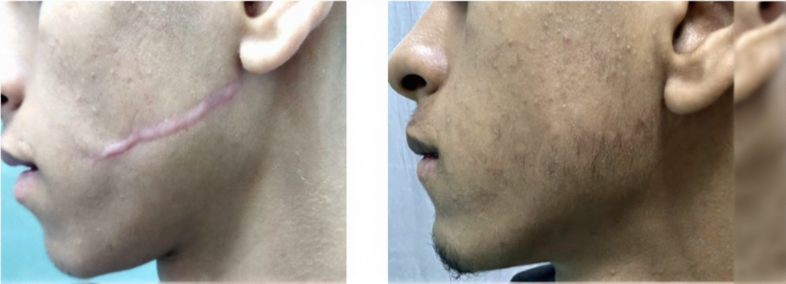 Résultat cicatrices traumatiques après traitement Peau régénérée après traitement des cicatrices traumatiques à Fès